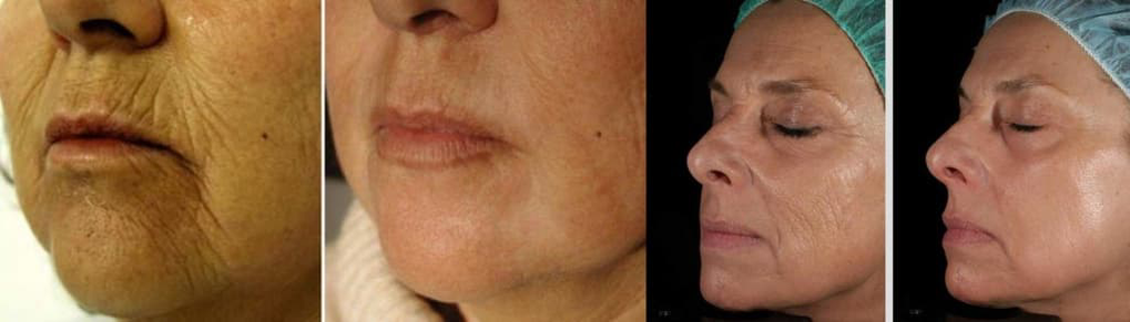 Δέρμα προσώπου πριν και μετά τη διαδικασία αναζωογόνησης με λέιζερ