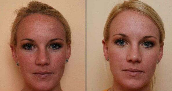 πριν και μετά την αναζωογόνηση του δέρματος του προσώπου με λέιζερ