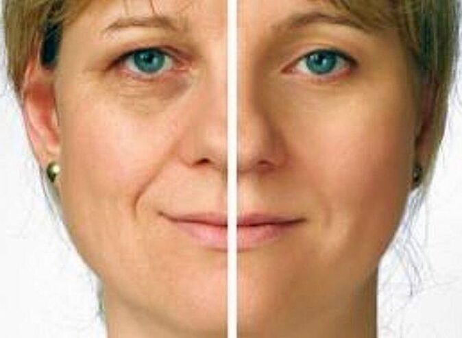 δέρμα γύρω από τα μάτια πριν και μετά την αναζωογόνηση